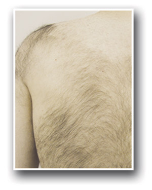 Laser-Hair-Removal-before